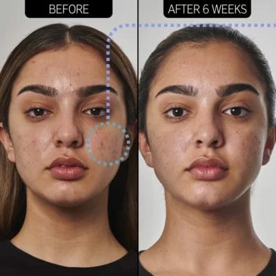The Inkey List Acne Solution - Image 4
