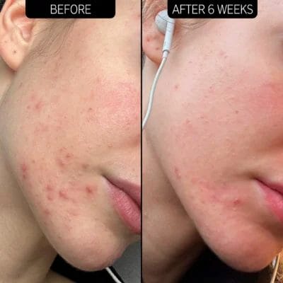 The Inkey List Acne Clearing Moisturizer 2% Novoretin - Image 2